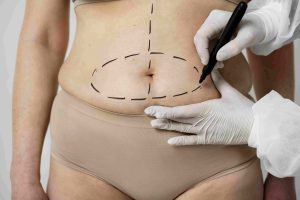 Tudo Sobre Lipoaspiração: Como Realçar Seu Contorno Corporal